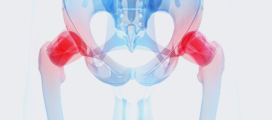 고관절질환
